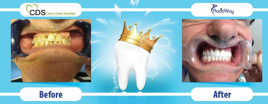 Before and After Results Dental Procedure in Cancun Mexico at Cancun Dental Specialists Before and After Results Dental Procedure in Cancun Mexico at Cancun Dental Specialists